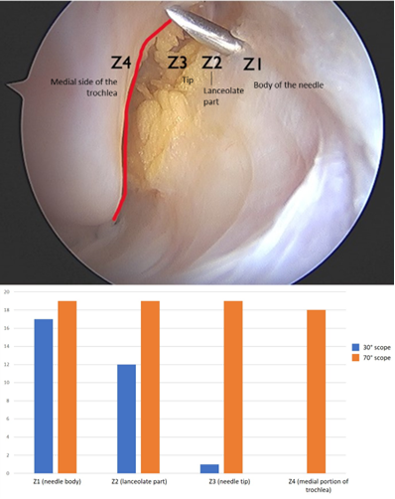 Four areas were selected for the analysis: body (Z1), lanceolate (Z2), tip of the needle (Z3) and medial portion of the trochlea (Z4). The areas were detected with the 30° (blue) and 70° scope (orange)