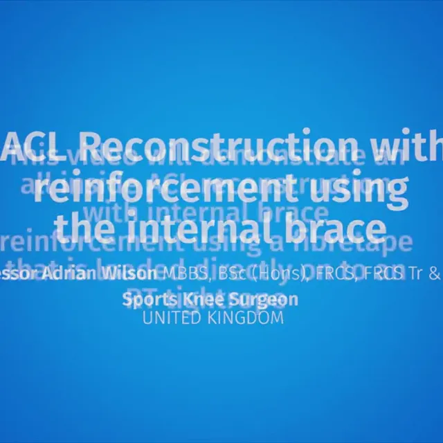 ACL reconstruction with reinforcement using the Internal Brace