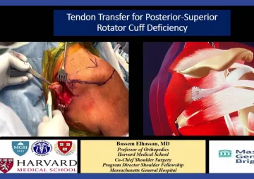 Tendon transfers in PS RC deficiency