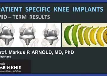 Patient Specific Knee Implants: Mid-term outcomes